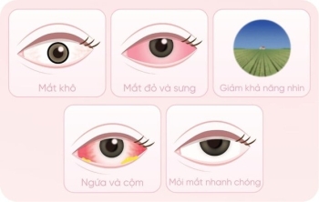 5 dấu hiệu mắt kích ứng khi đeo Lens không nên bỏ qua
